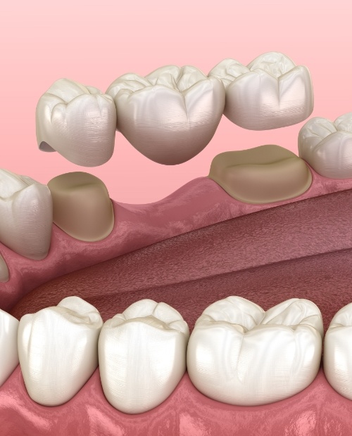 Animated smile during dental bridge placement