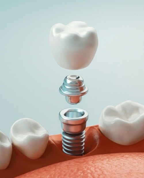How dental implants work in Billerica