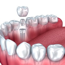 Dental implant in Billerica