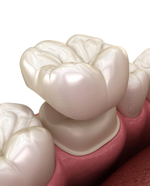 Illustration of dental crown being placed on tooth