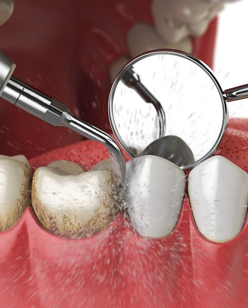 Female patient having teeth examined with dental mirror