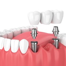 illustration of an implant bridge in Billerica