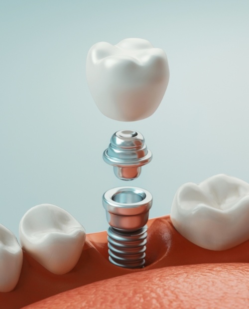 Animated components of a dental implant supported replacement tooth