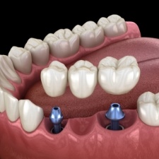 Animated smile during dental implant supported fixed bridge placement