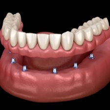 Animated smile during dental implant supported denture placement