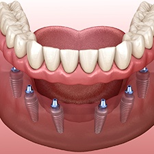 3D render of implant dentures