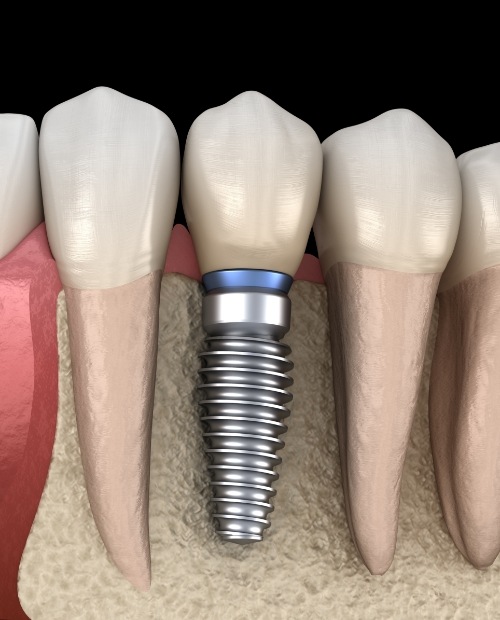 Animated smile with dental implant supported replacement tooth