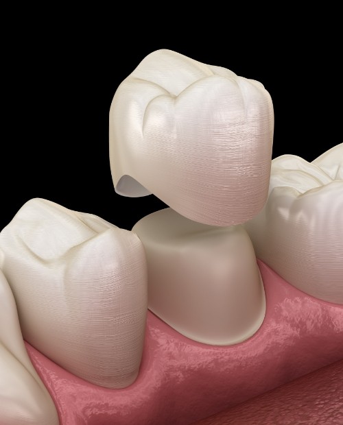 Animated smile during dental crown placement