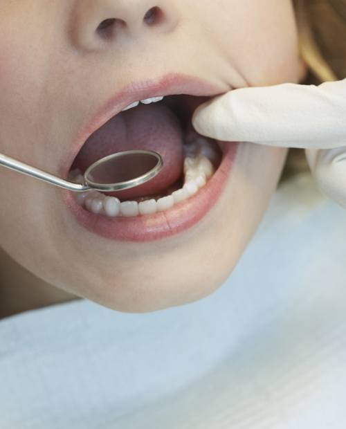 Dentist examining smile after placing dental sealants