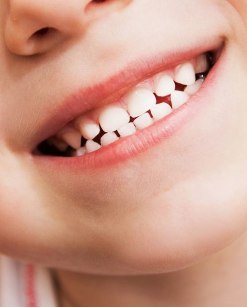 Child's smile after silver diamine fluoride treatment