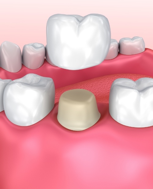 Animated smile during metal free dental crown placement