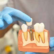 dentist placing a crown on a dental implant model