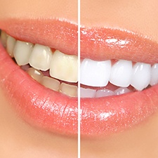 Closeup of a smile that’s halved to show results of teeth whitening