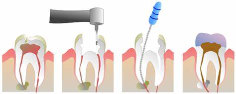 illustration showing root canal process