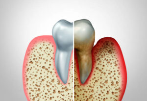 Healthy tooth and tooth affected by gum disease