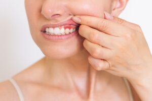Woman holding back upper lip to show red gums.